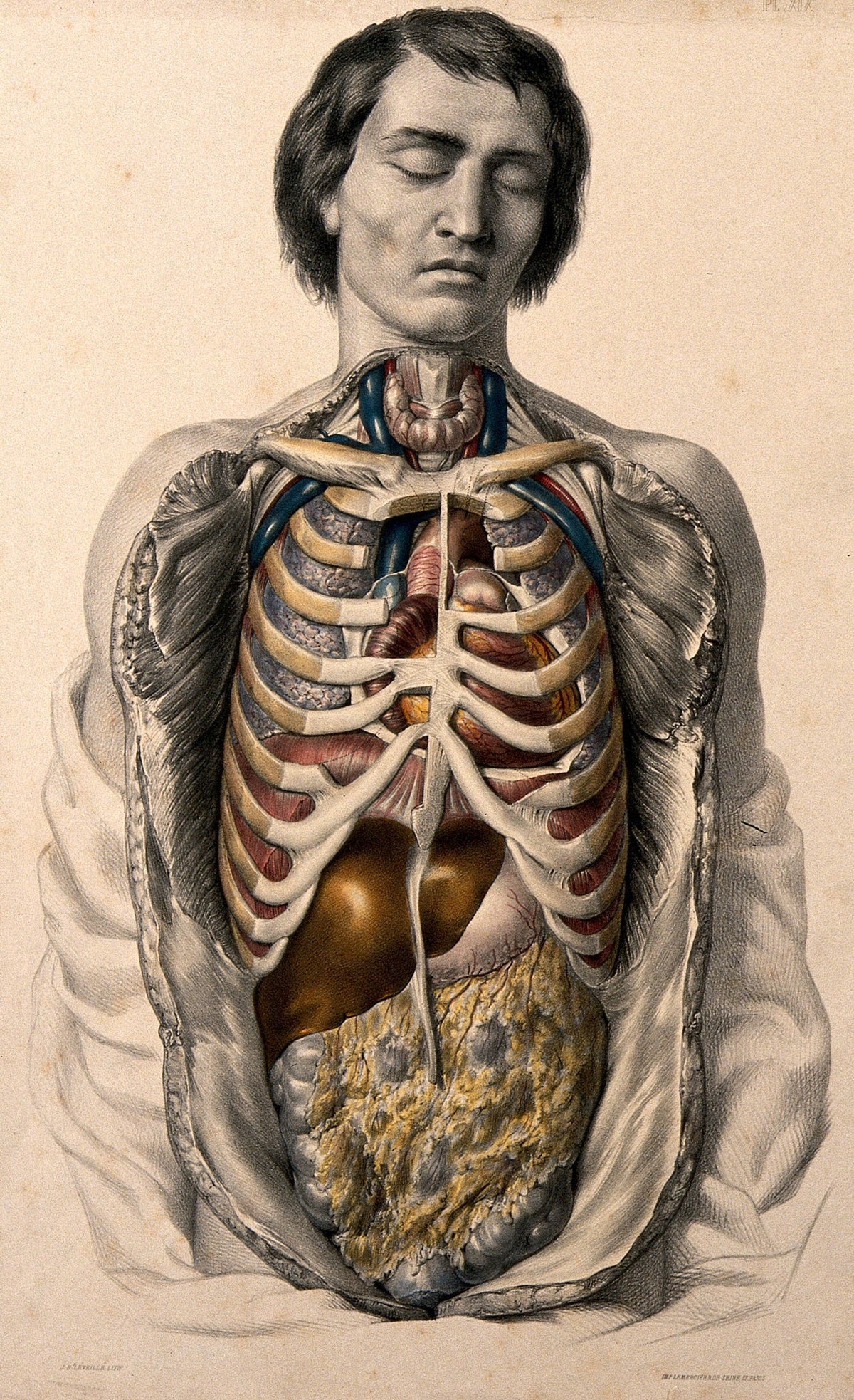 The Body Of a Man With His Trunk Dissected by William Fairland - Giclee Print on Canvas with Magnetic Hanger